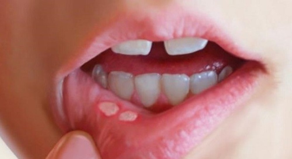 Những điều cần biết về bệnh nhiệt miệng
