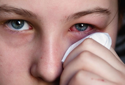 istock photo of woman holding tissue to reddened eye