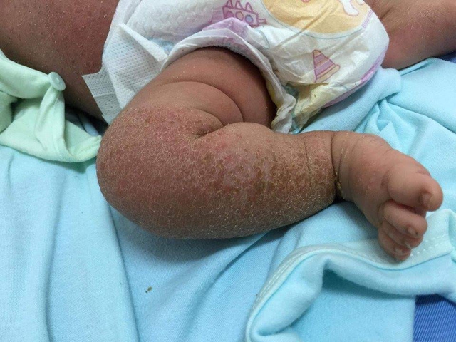 Bé 1 tháng tuổi bị bong tróc toàn thân do tắm lá thường xuyên - Ảnh minh hoạ 2