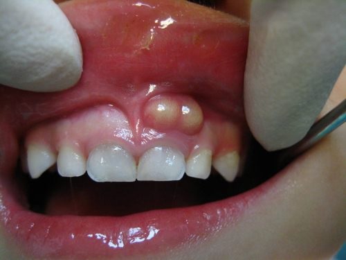viêm chân răng 1